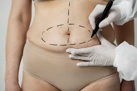 Sorteo Abdominoplastia