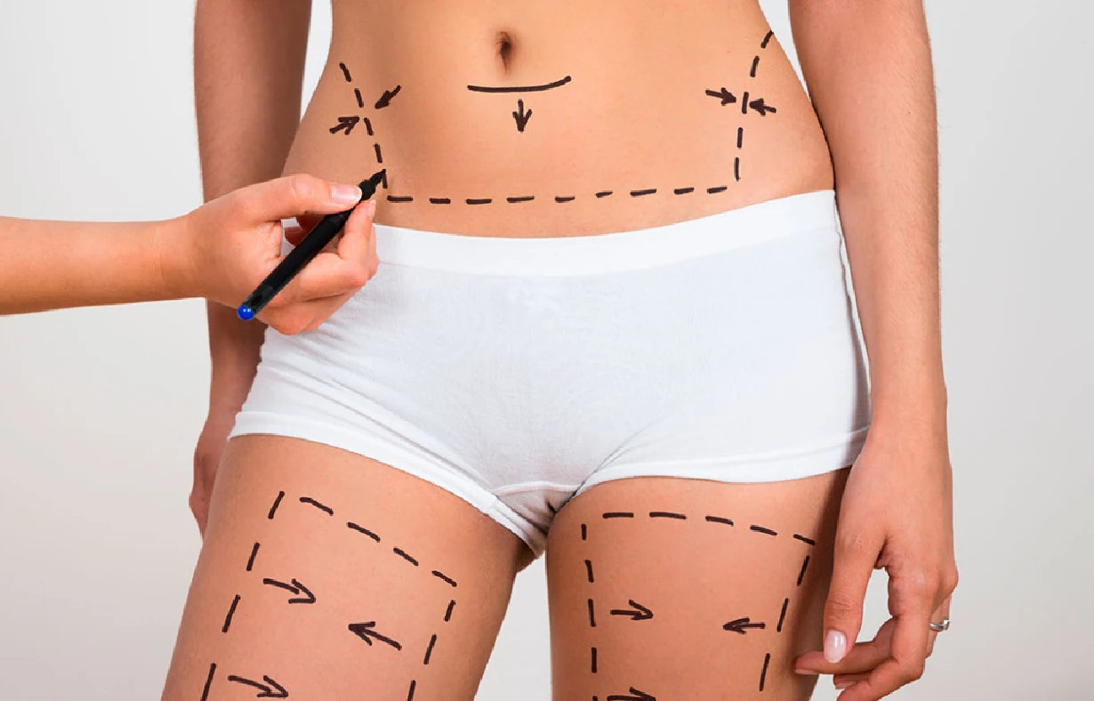 Sorteo Liposucción/ lipoescultura